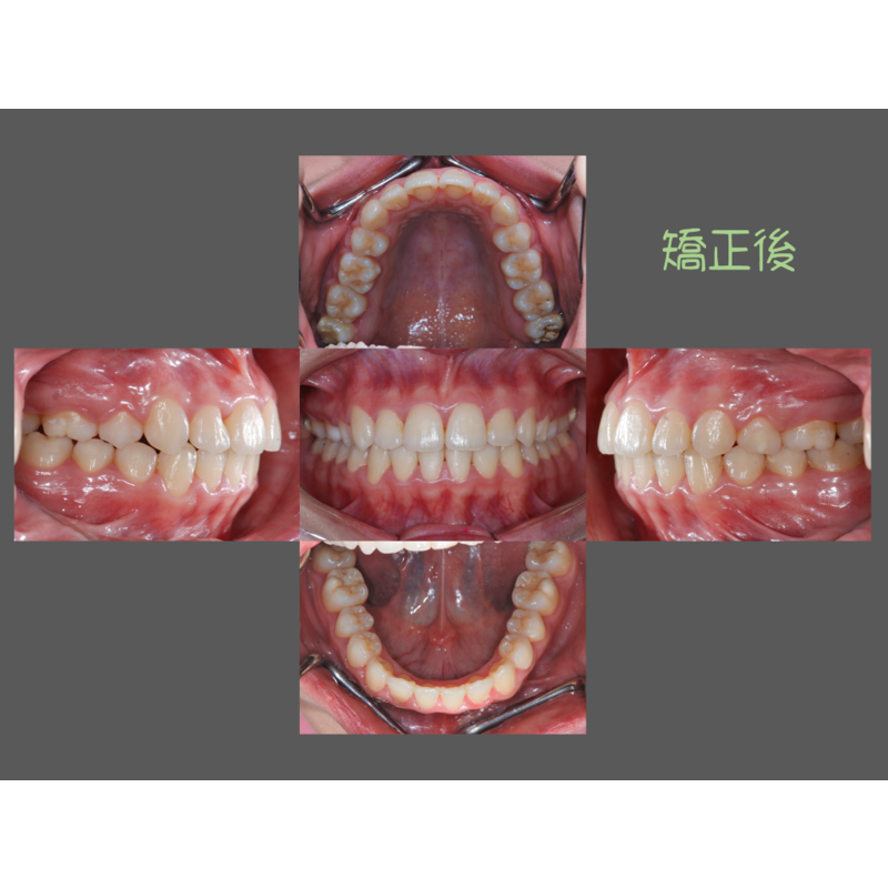 Case Three Crowded Teeth