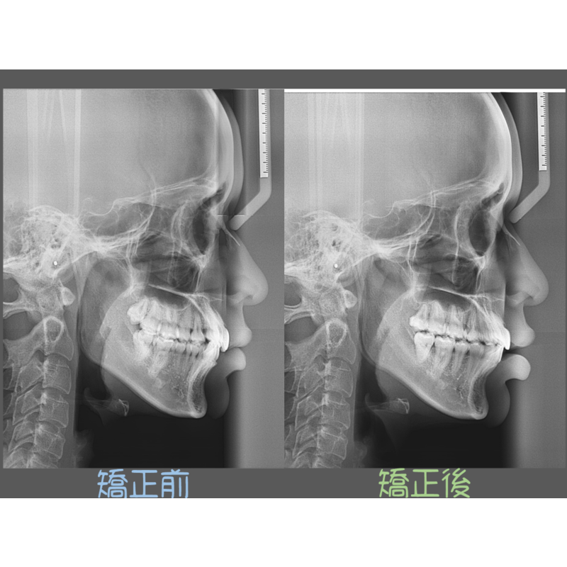 Case Three Crowded Teeth