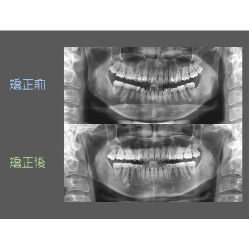 Case Three Crowded Teeth