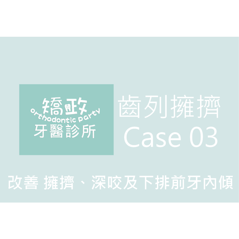 Case Three Crowded Teeth