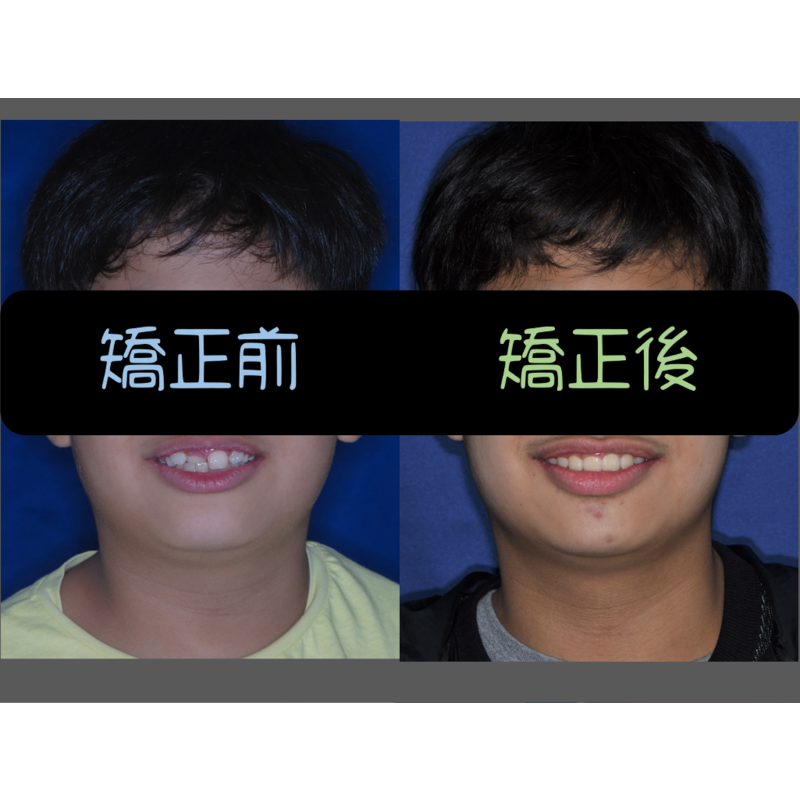 Case Three Invisalign