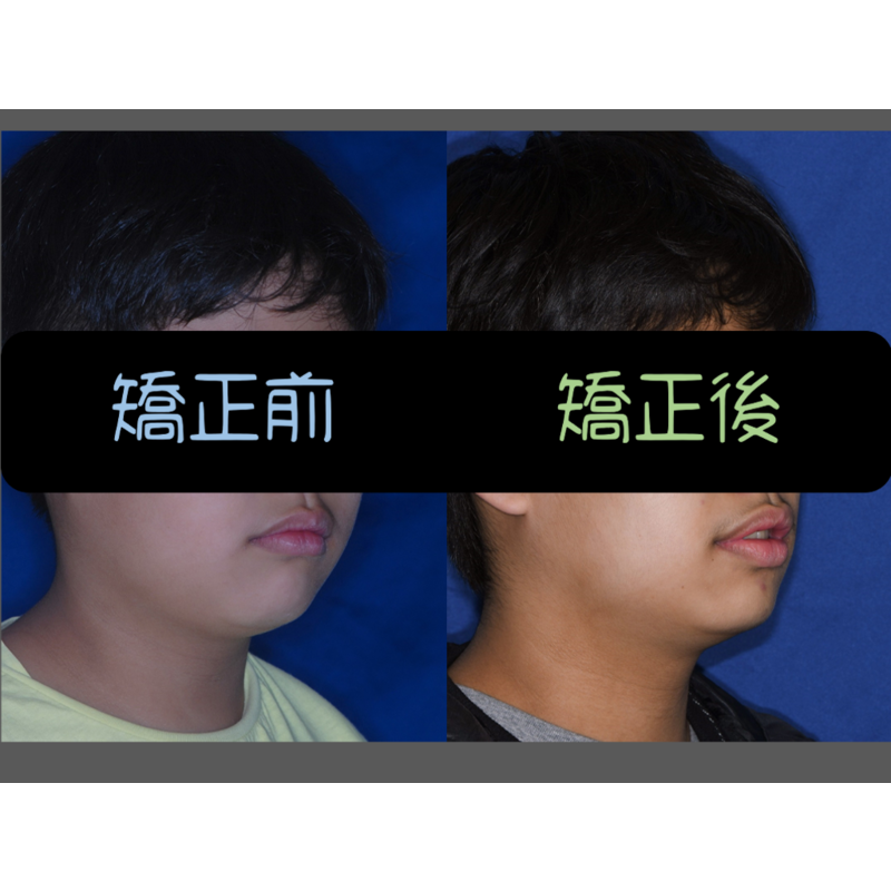 Case Three Invisalign