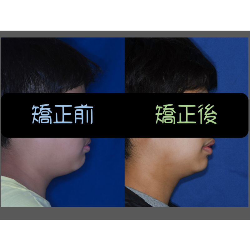 Case Three Invisalign