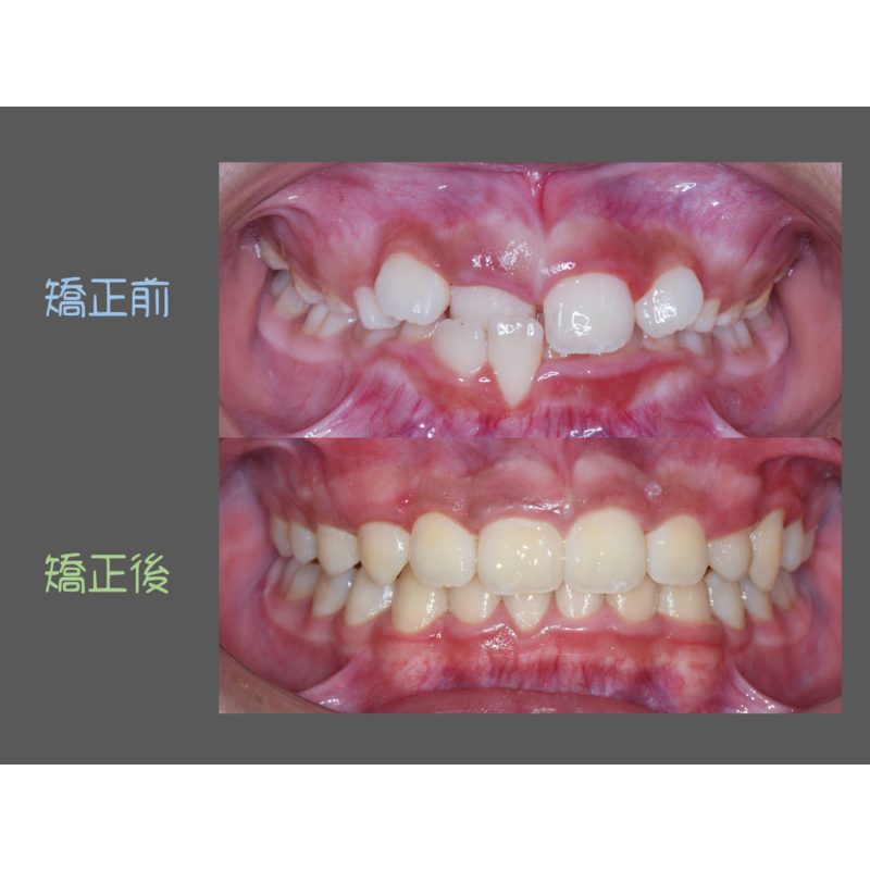 Case Three Invisalign
