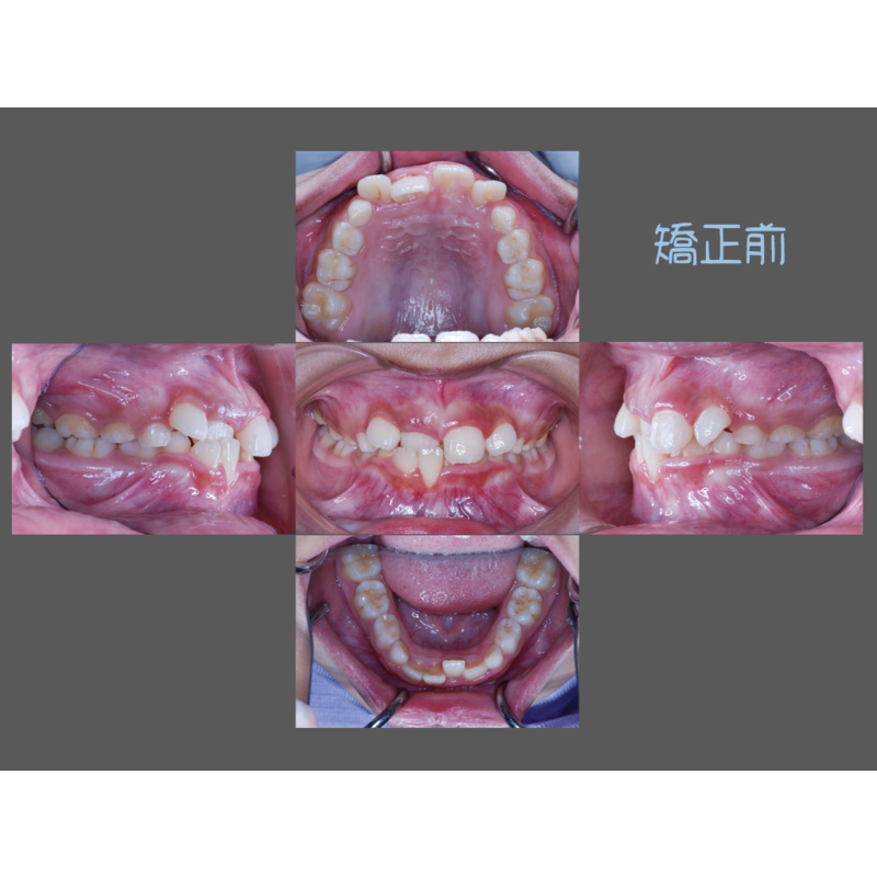 Case Three Invisalign