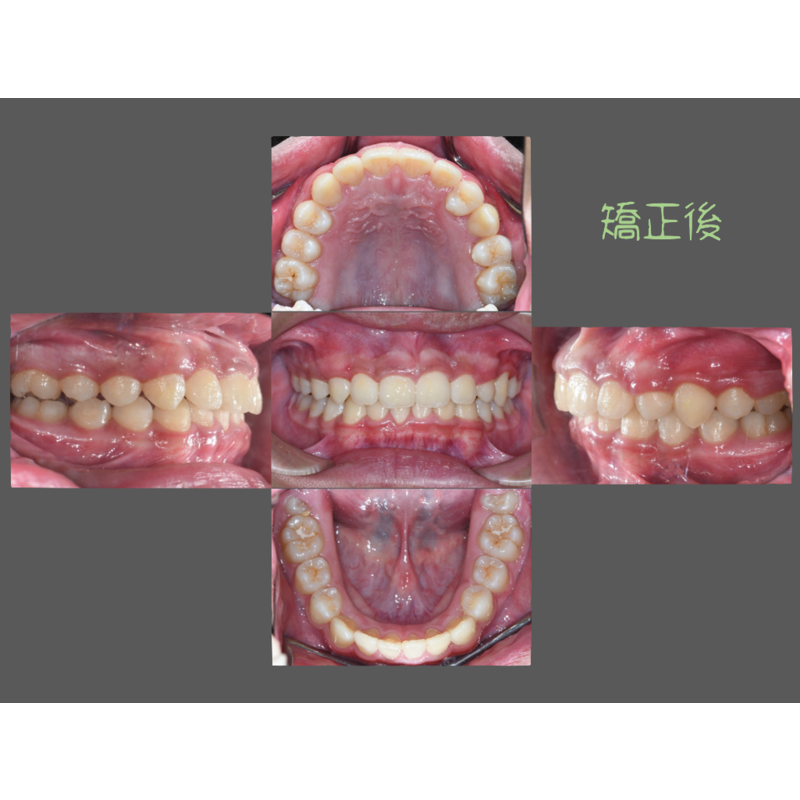 Case Three Invisalign