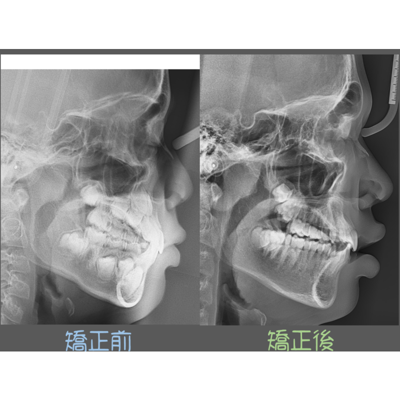 Case Three Invisalign