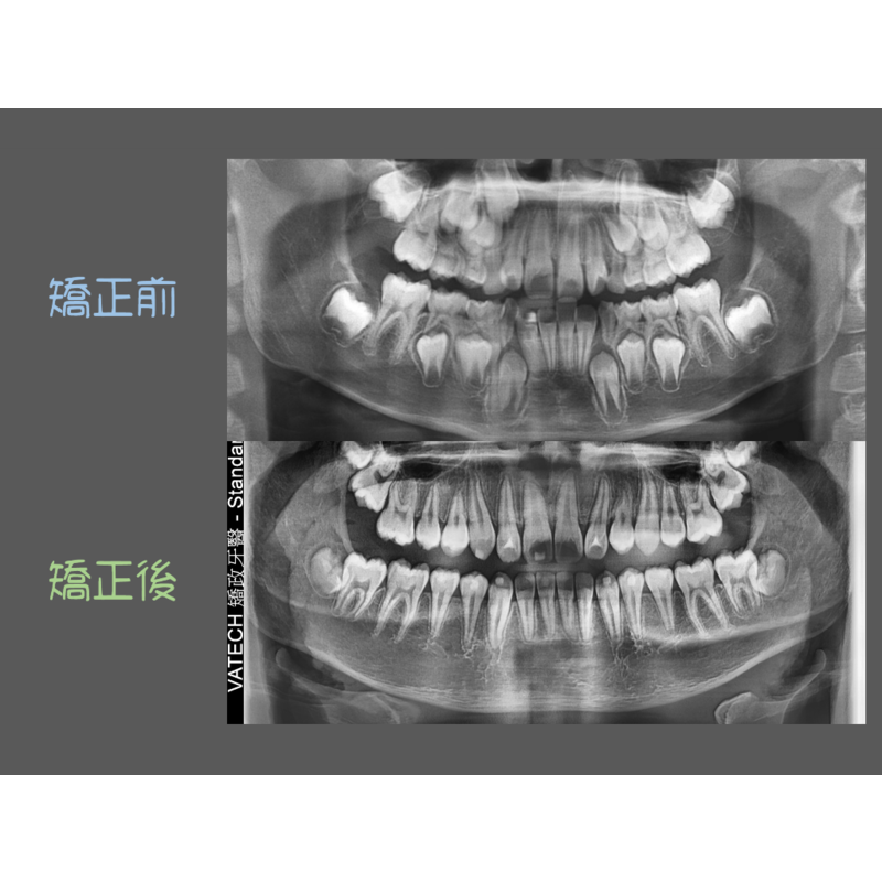 Case Three Invisalign