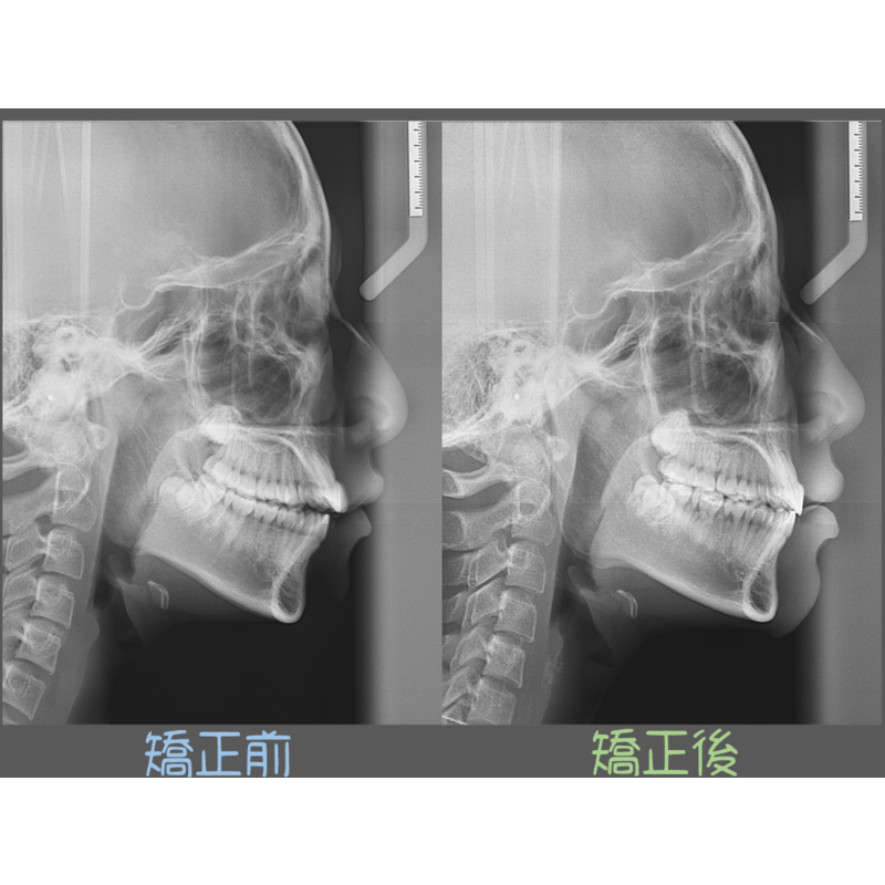 Case Two Bite