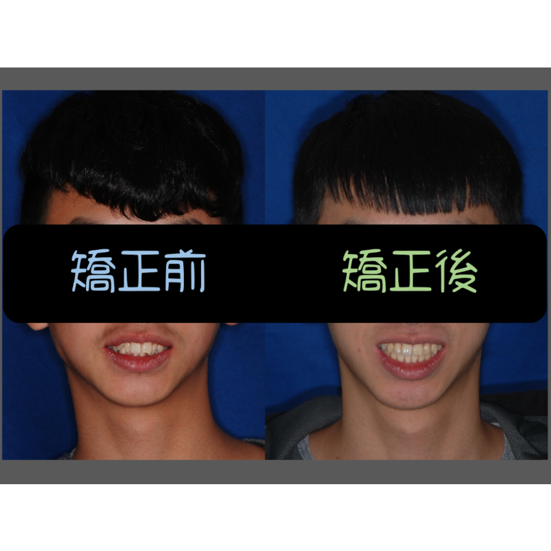 Case Two Crowded Teeth