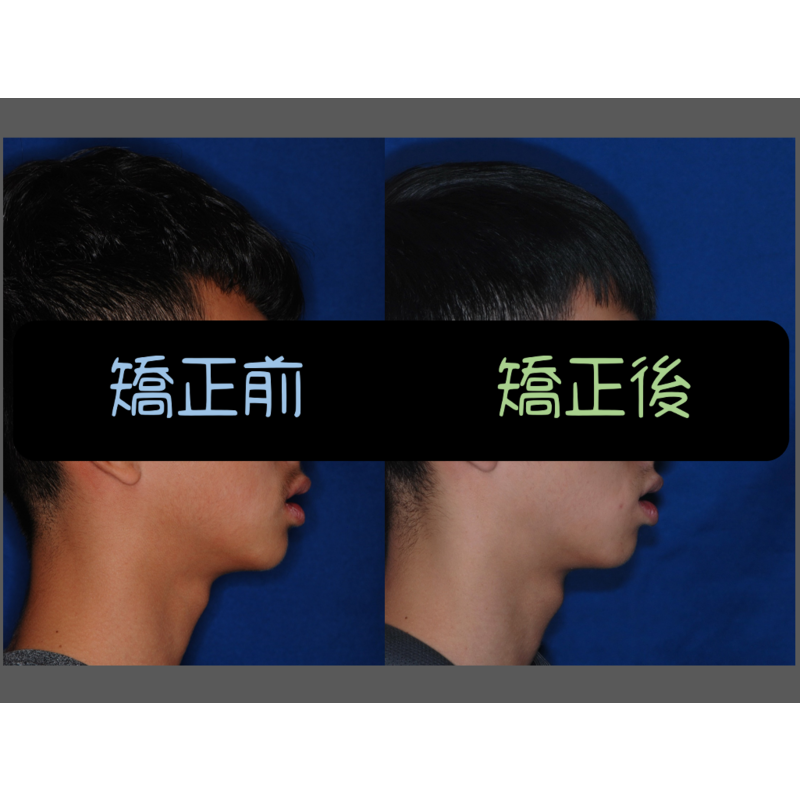 Case Two Crowded Teeth