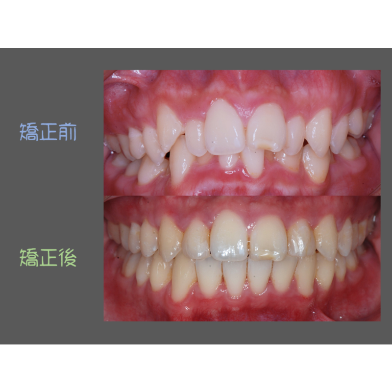 Case Two Crowded Teeth