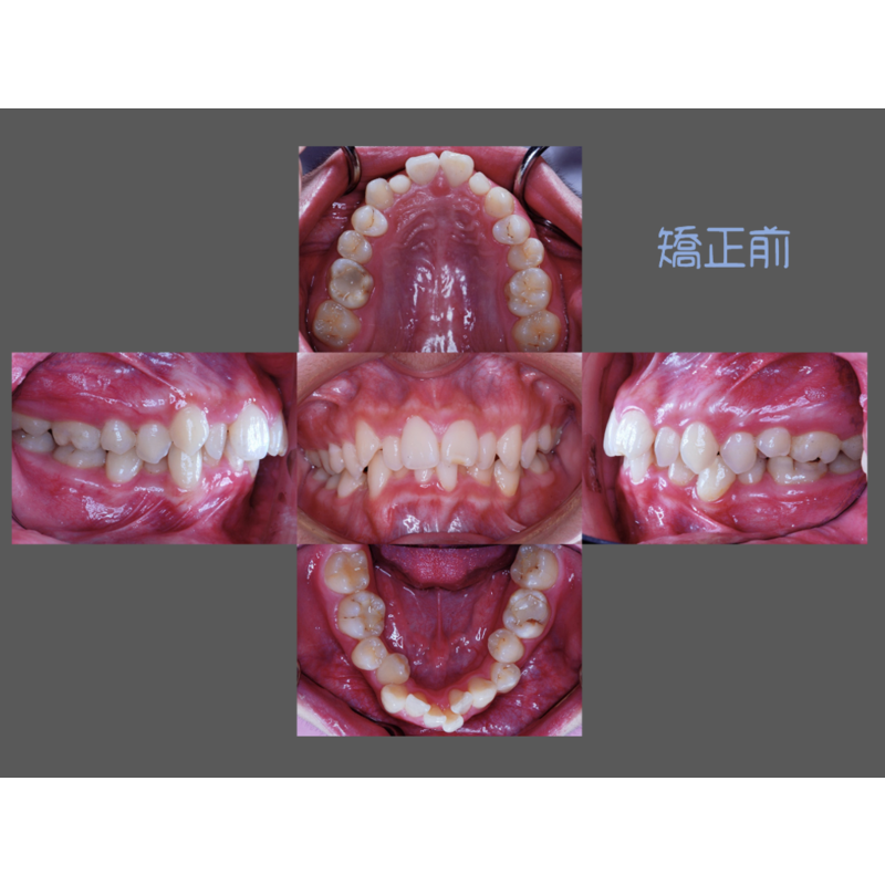 Case Two Crowded Teeth