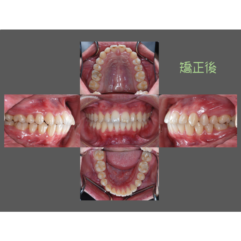 Case Two Crowded Teeth