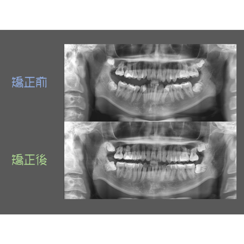 Case Two Crowded Teeth
