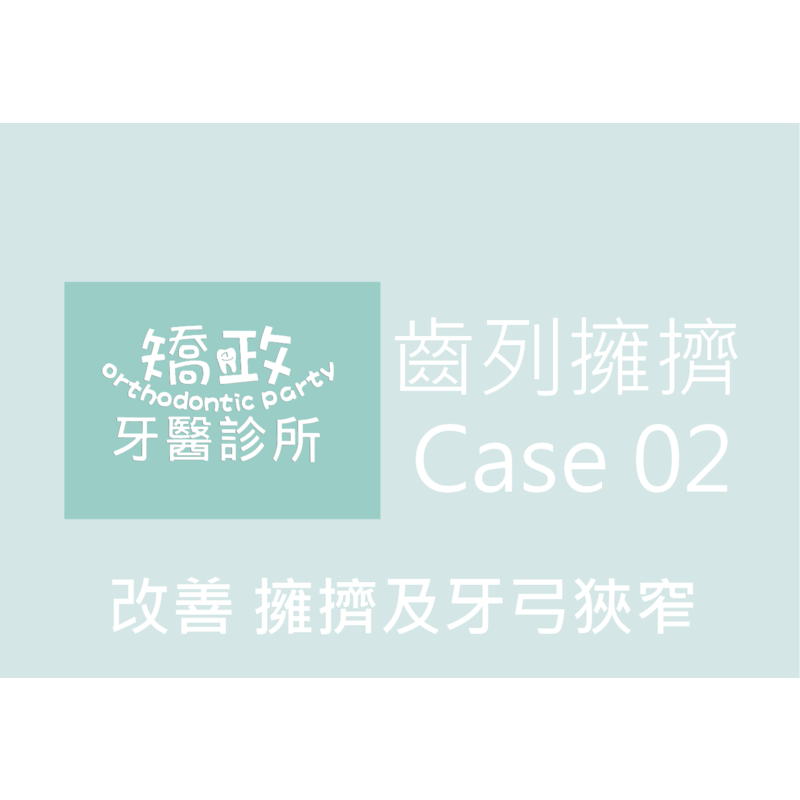 Case Two Crowded Teeth