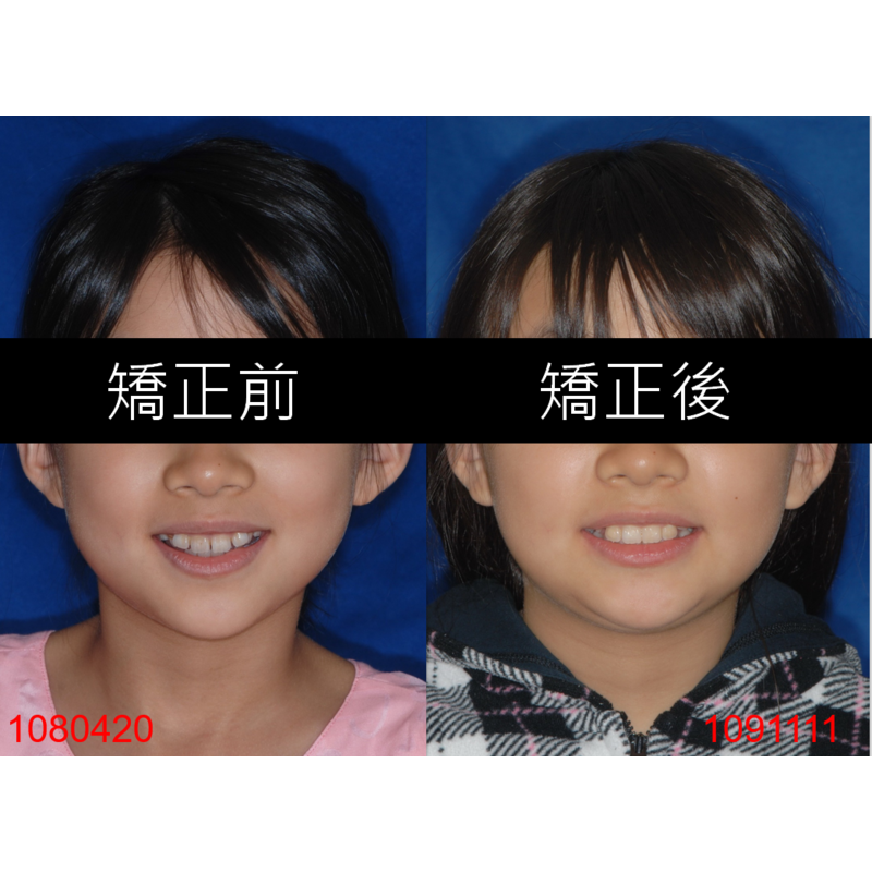 Case Two Invisalign