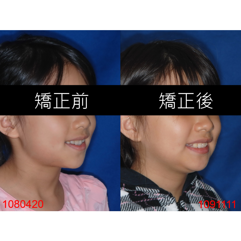 Case Two Invisalign