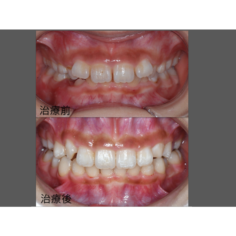 Case Two Invisalign