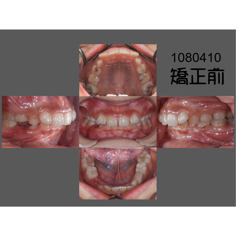 Case Two Invisalign