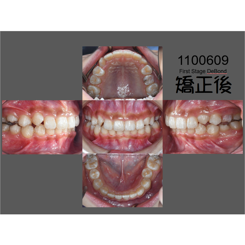 Case Two Invisalign