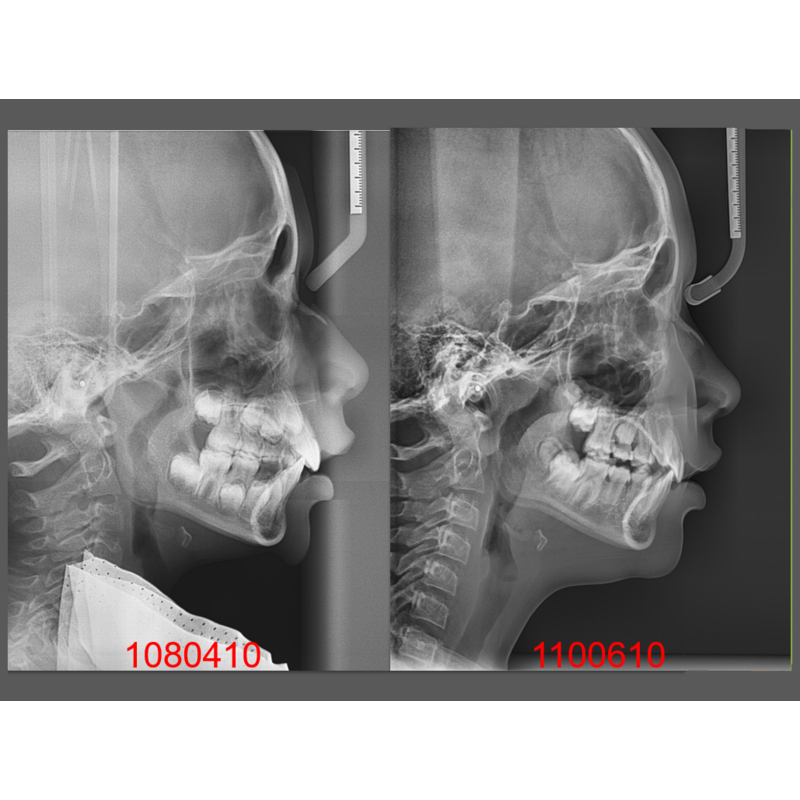 Case Two Invisalign