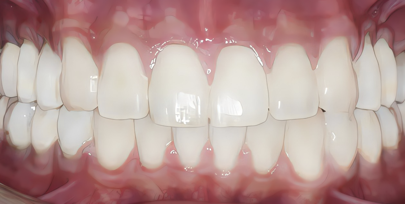 Dental Implant