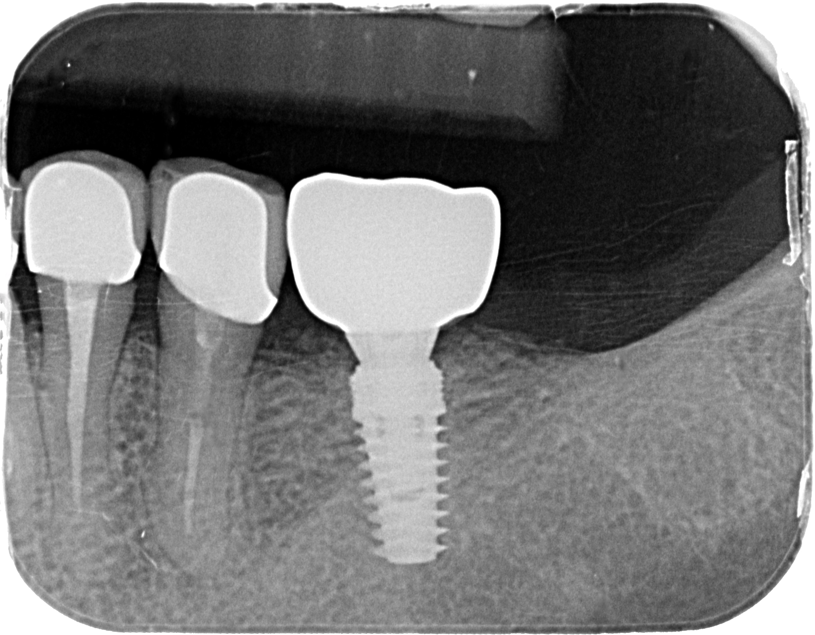 Dental Implant
