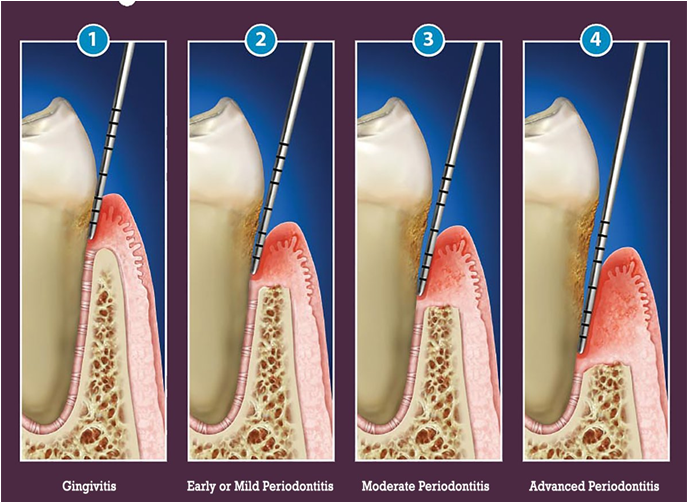 Periodontal