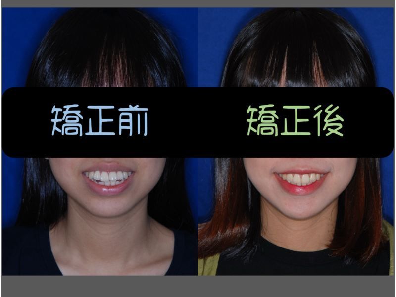 case one protruding teeth