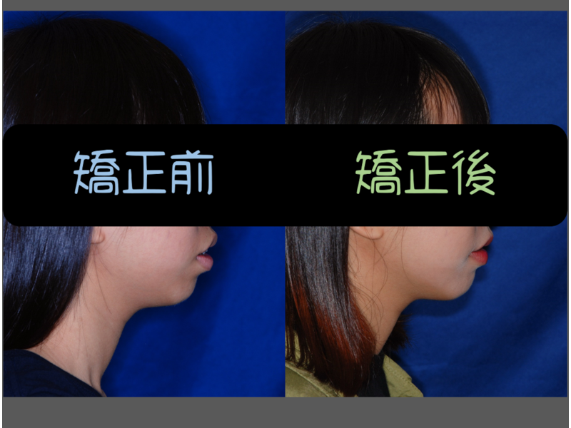 case one protruding teeth