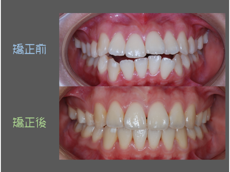 case one protruding teeth
