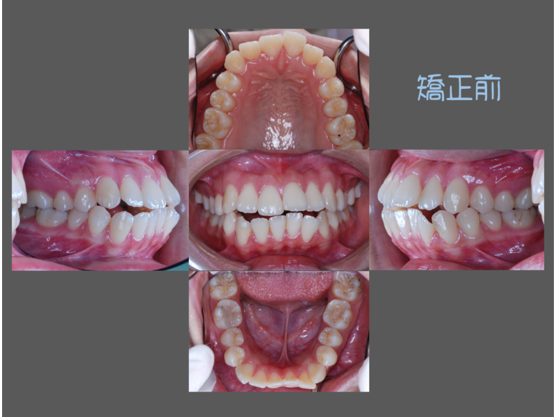 case one protruding teeth