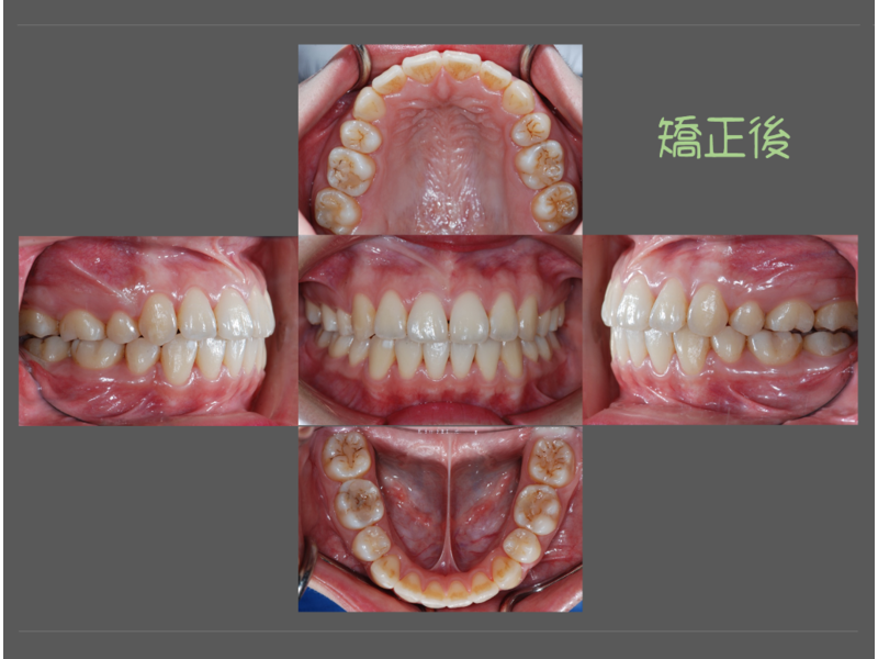 case one protruding teeth