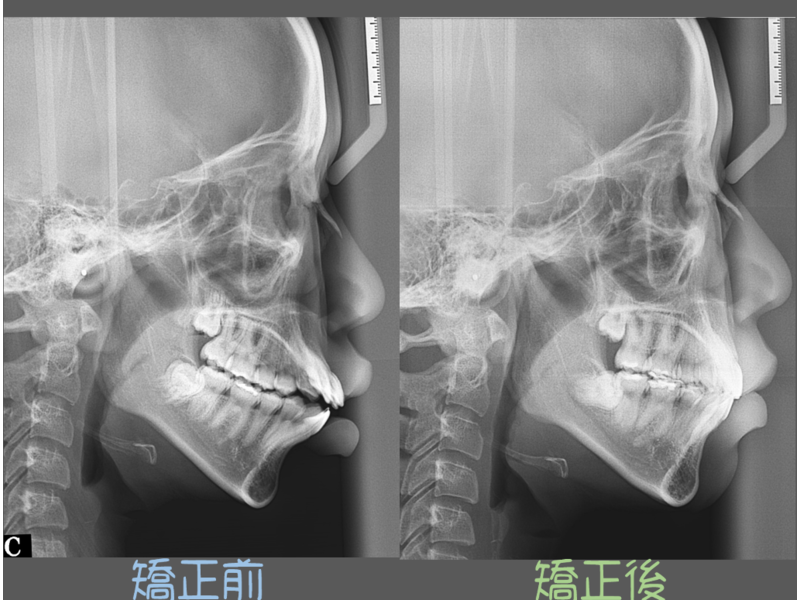 case one protruding teeth
