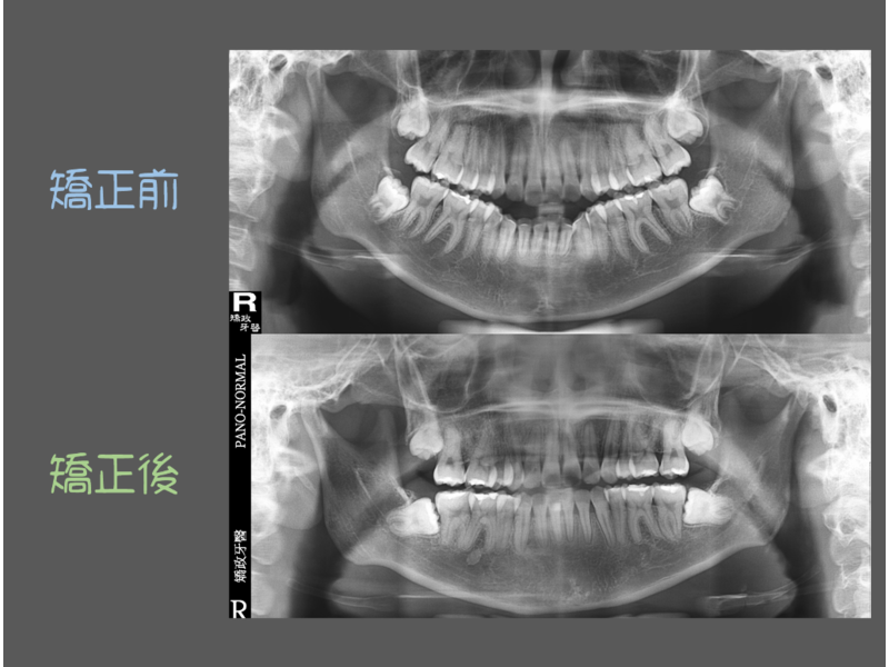 case one protruding teeth