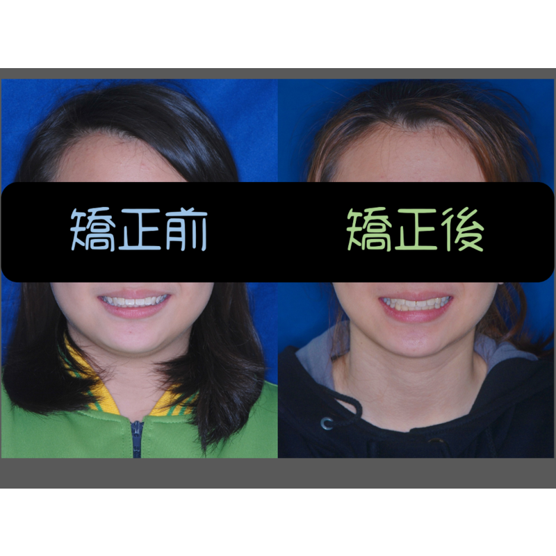 case 2 protruding teeth
