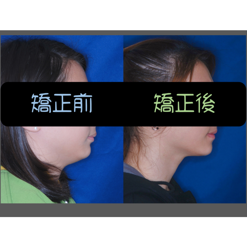 Case Two Protruding teeth