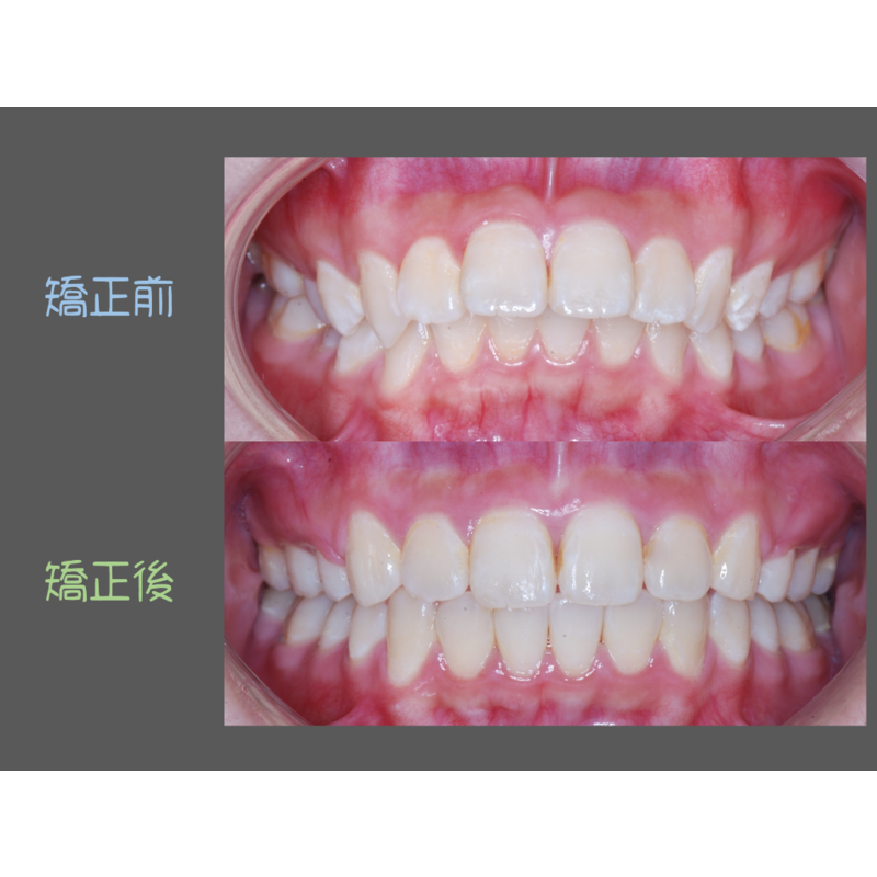 Case Two Protruding teeth