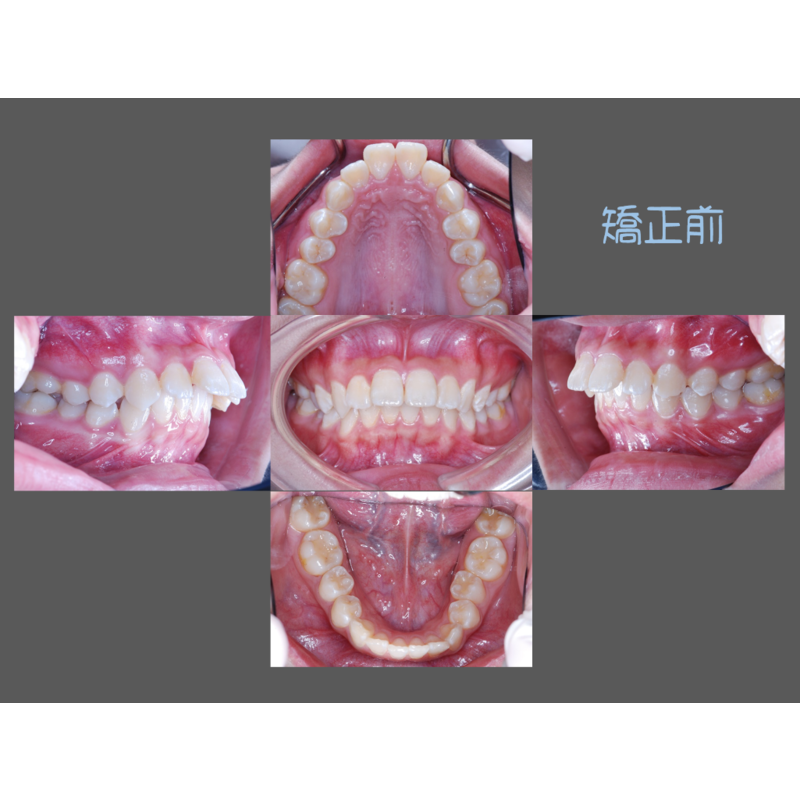 Case Two Protruding teeth
