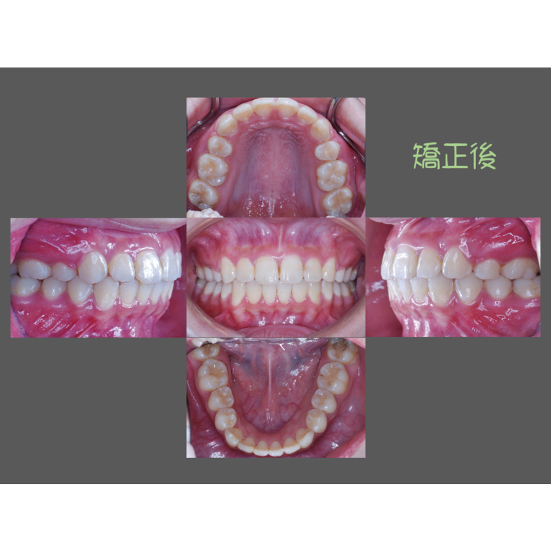 Case Two Protruding teeth