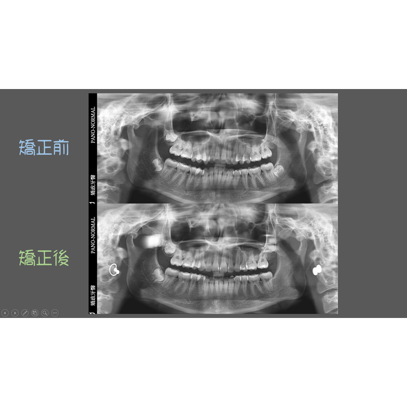 Case Two Protruding teeth