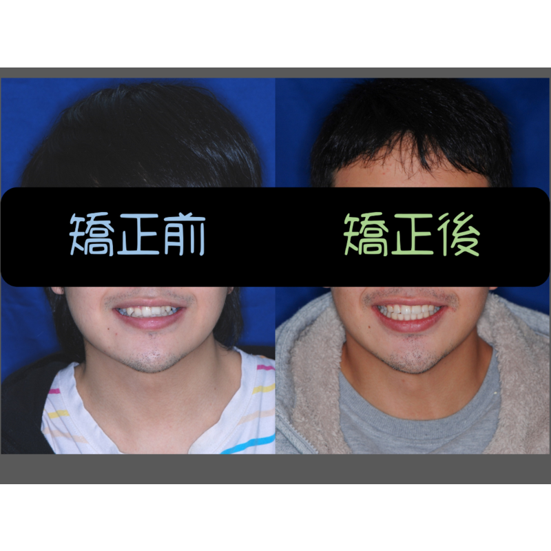 Case Three Protruding Teeth