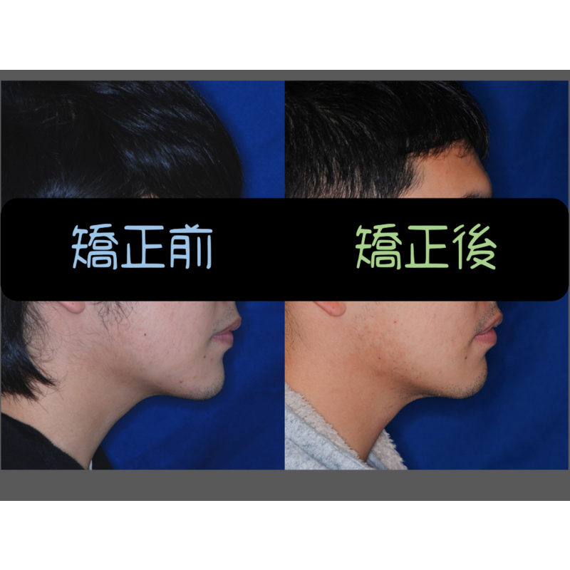 Case Three Protruding Teeth