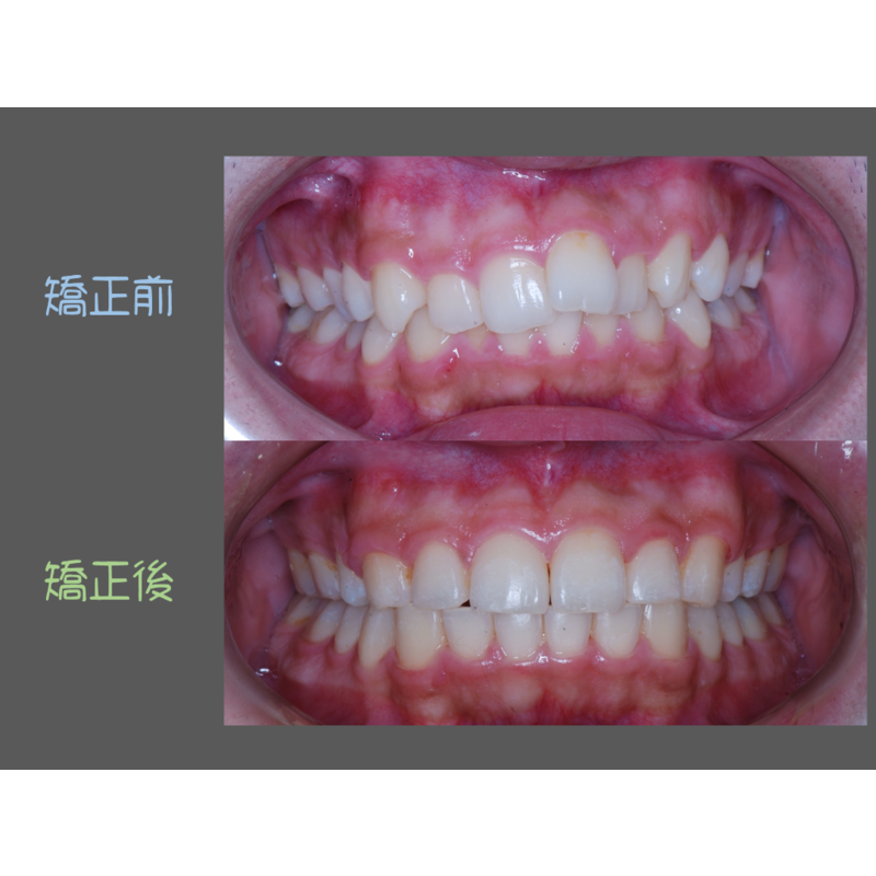 Case Three Protruding Teeth