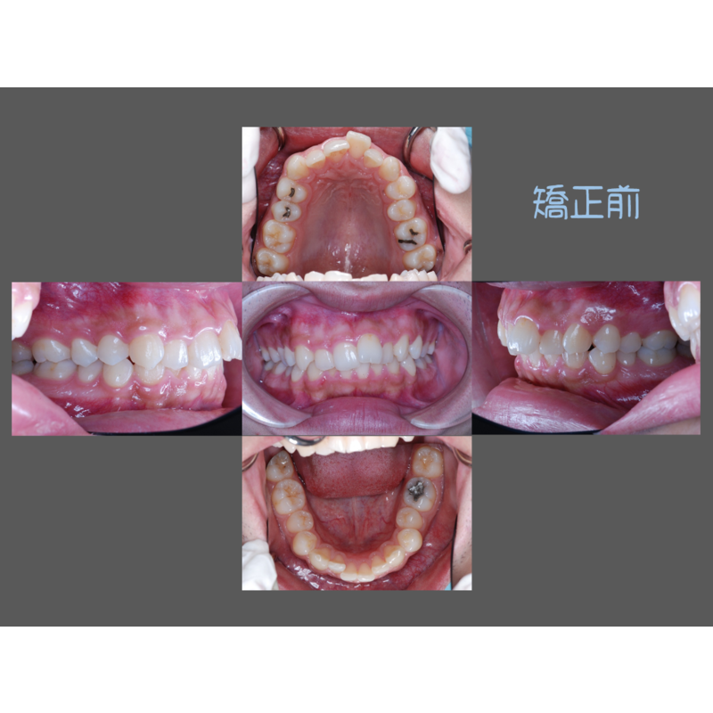 Case Three Protruding Teeth