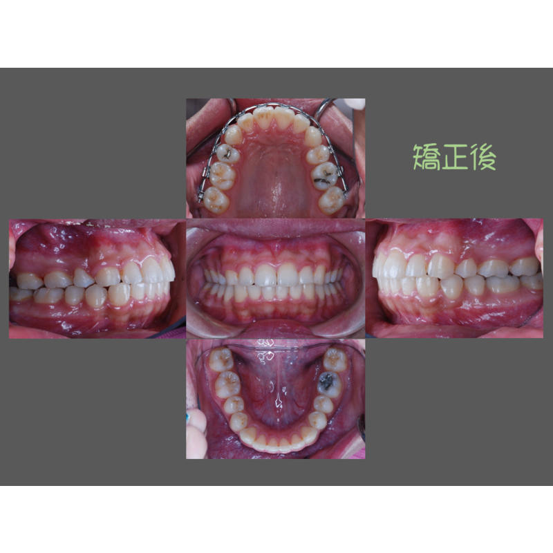 Case Three Protruding Teeth