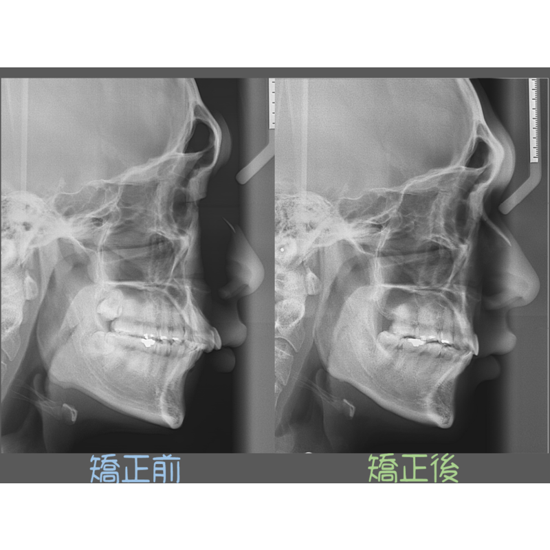 Case Three Protruding Teeth