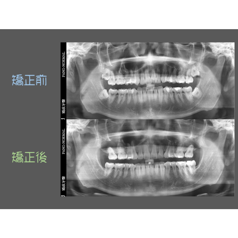 Case Three Protruding Teeth