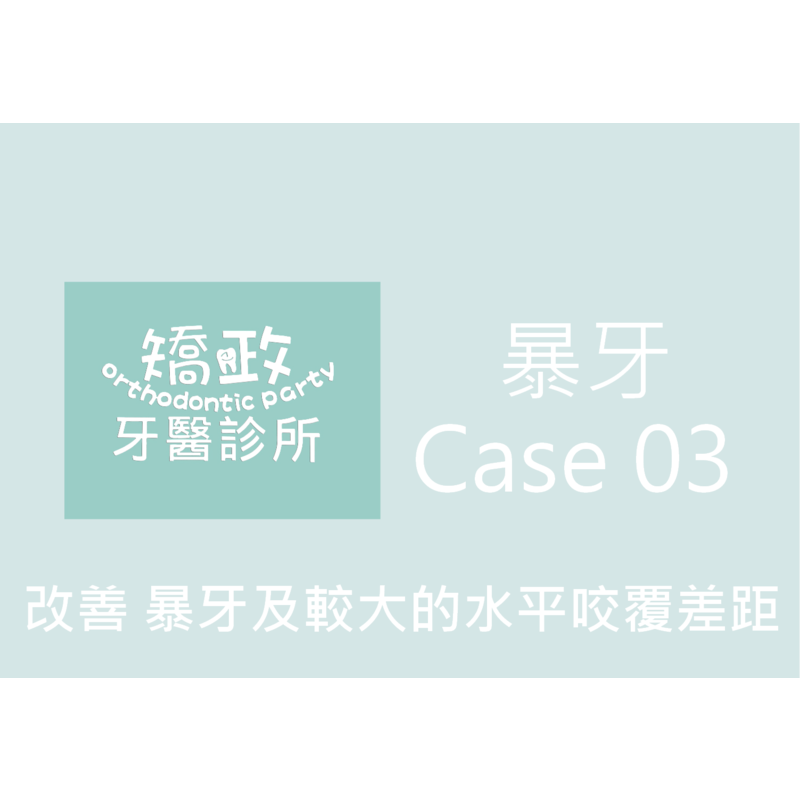 Case Three Protruding Teeth